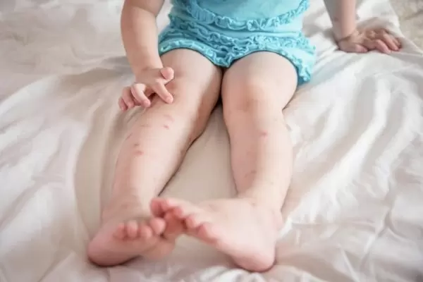 Аллергия на комаров у детей фото