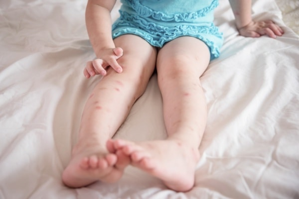 Аллергия на комаров у детей фото