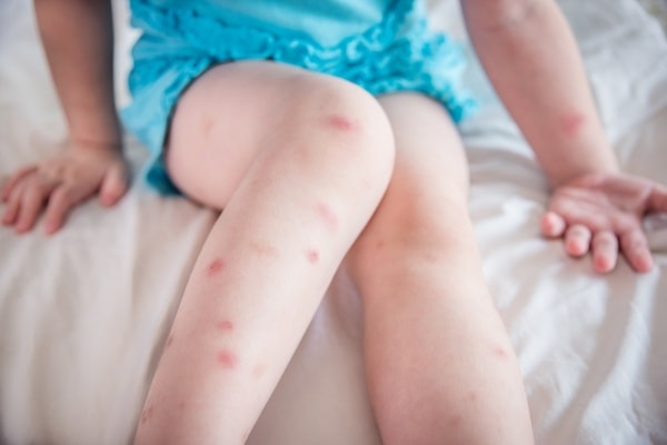 Аллергия на укус комара у ребенка фото