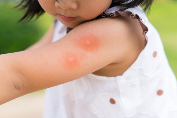 Аллергия у ребенка на укусы комаров фото
